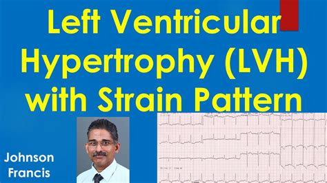 lv strain pattern on ecg|lvh strain pattern vs ischemia.